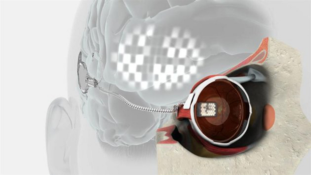 Un implante biónico devuelve la visión