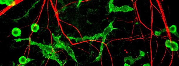 ¿Cómo logra el cerebro definir tus movimientos? Pacientes con Parkinson podrían darnos la respuesta