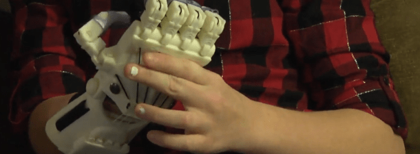 La impresión 3D pone los dedos que le faltan en la mano derecha a esta niña
