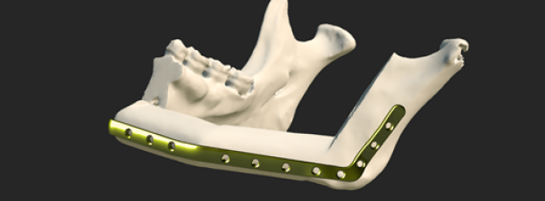 Osteophoenix, salud a medida en 3D