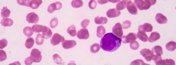 Un modelo “in-vivo” de la leucemia siembra la esperanza