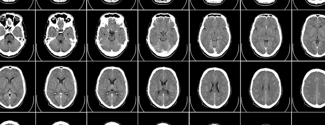 cerebro radiografía