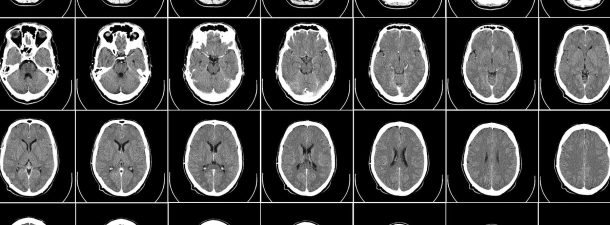 Crean un mini cerebro capaz de generar movimiento muscular