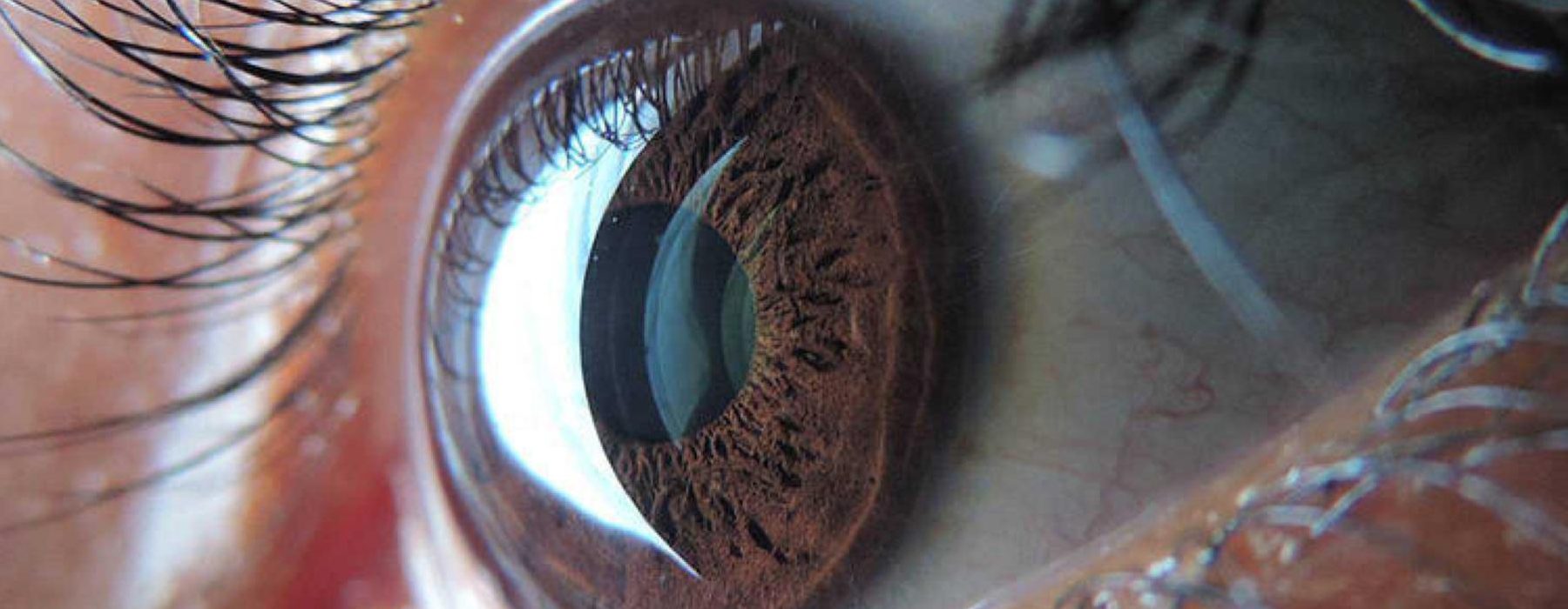 Diagnóstico oftalmológico en tiempo real por 5G utilizando tecnología de la Fórmula 1