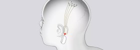 Qué se puede esperar de los primeros ensayos de Neuralink